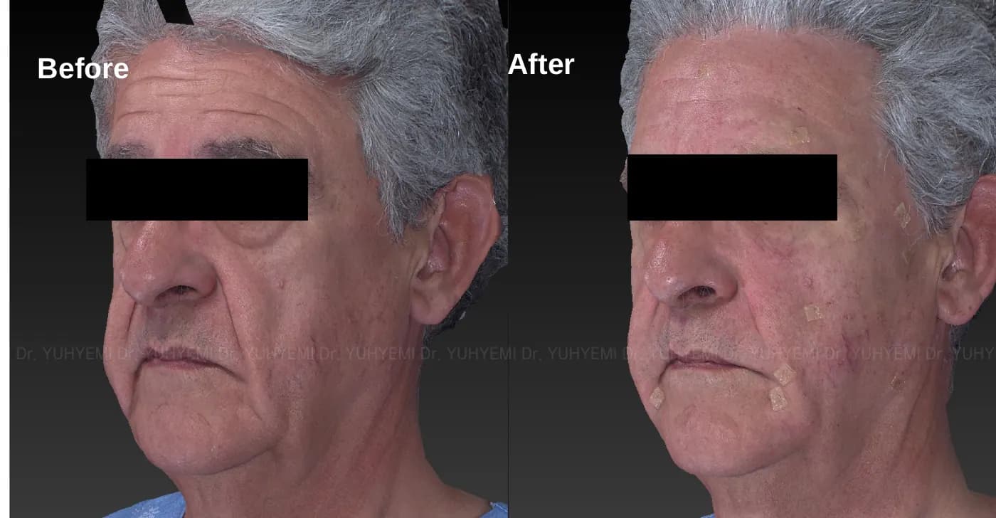 Radiesse before and after, case 1