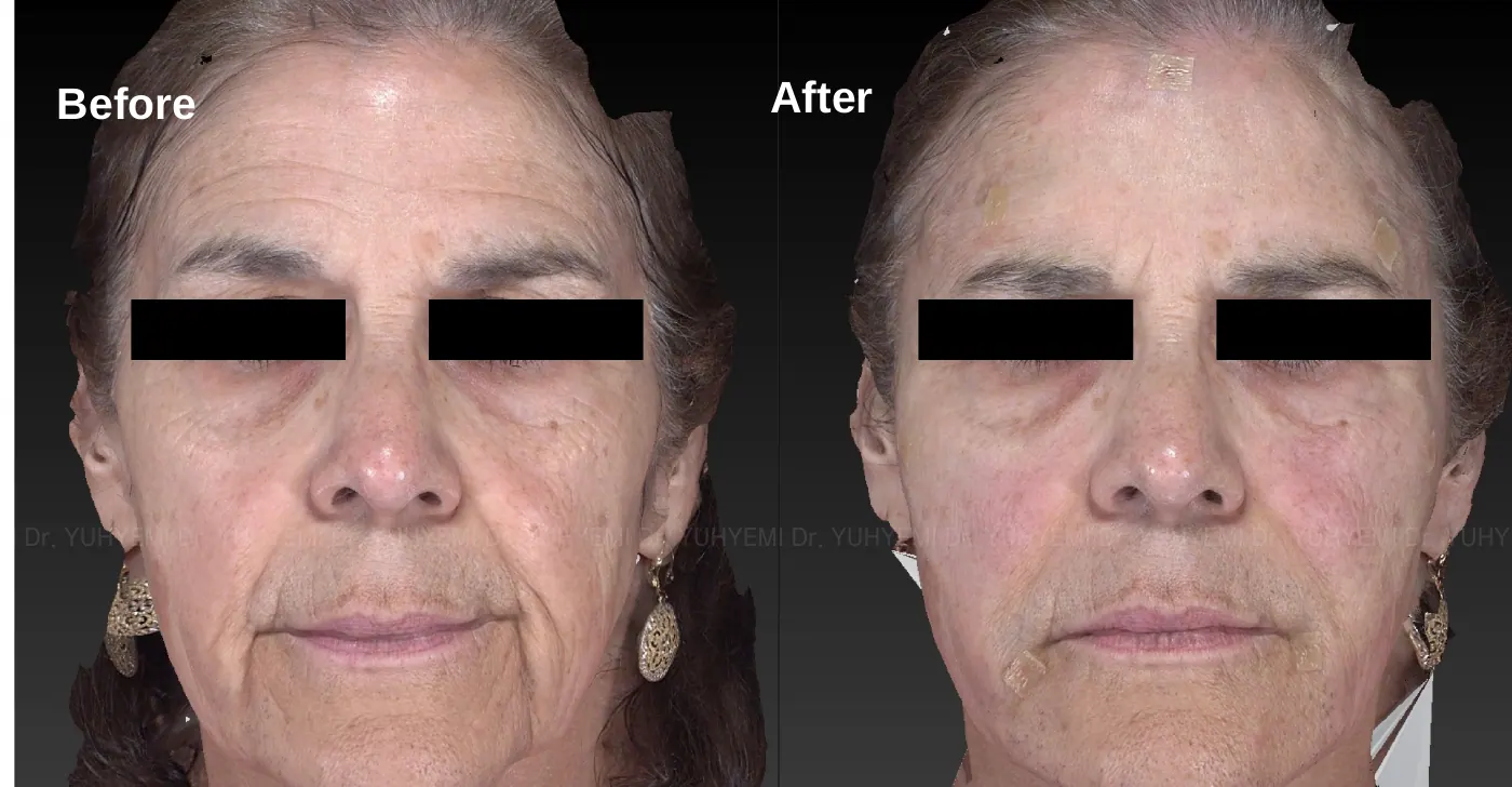 Radiesse before and after, case 2