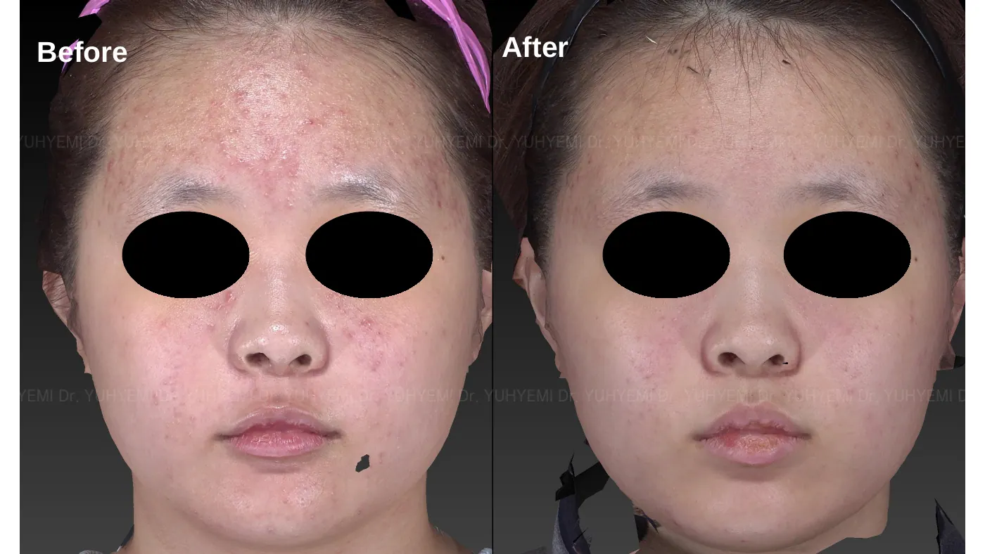 Skin & Barrier before and after, case 1