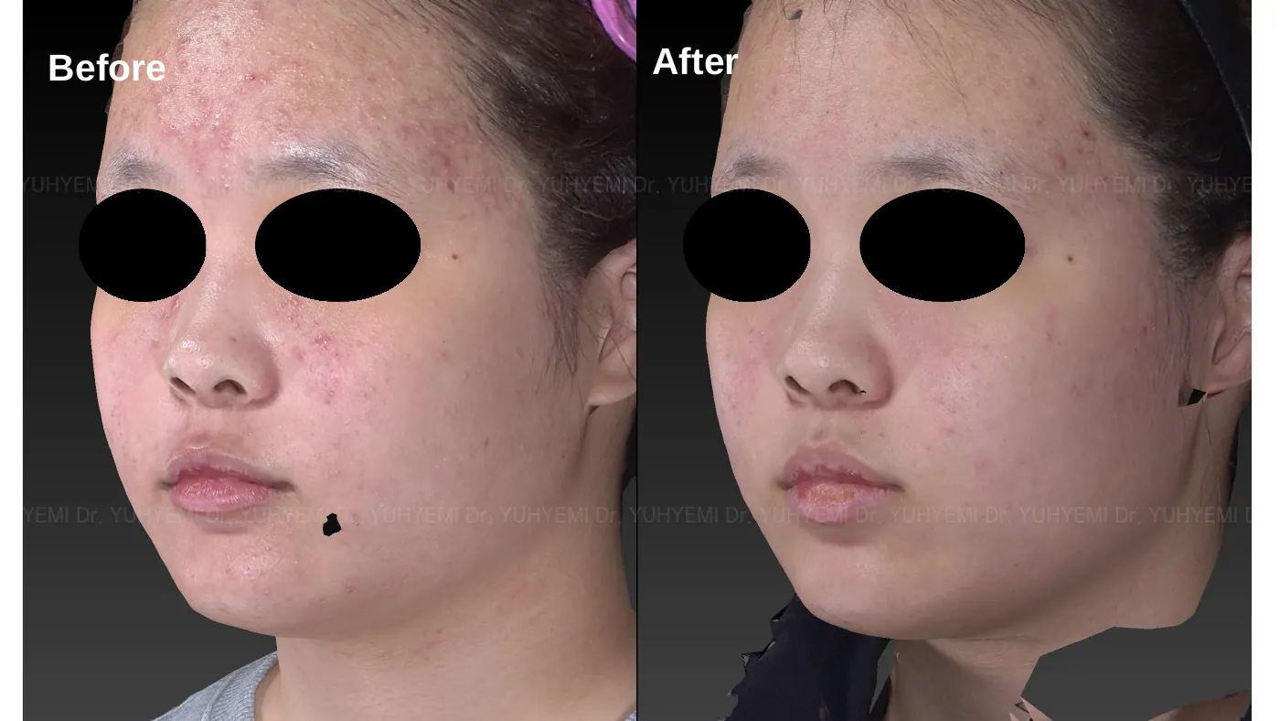 Skin & Barrier before and after, case 2