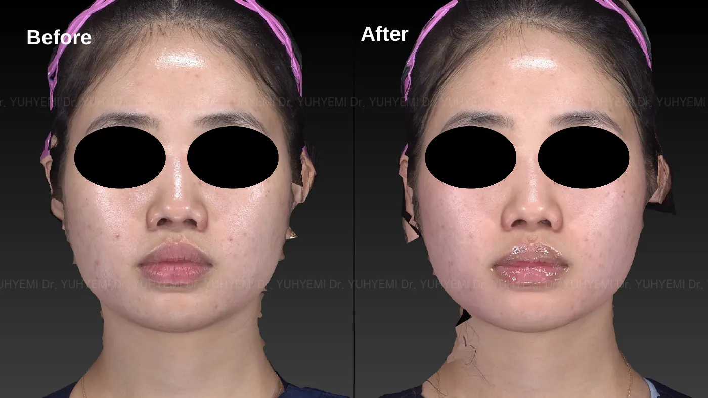 Skin & Barrier before and after, case 3