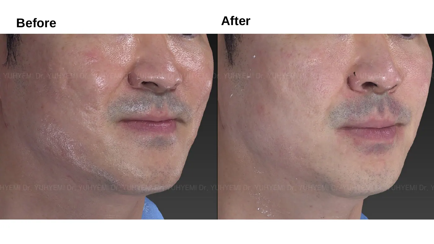 Skin & Barrier before and after, case 4