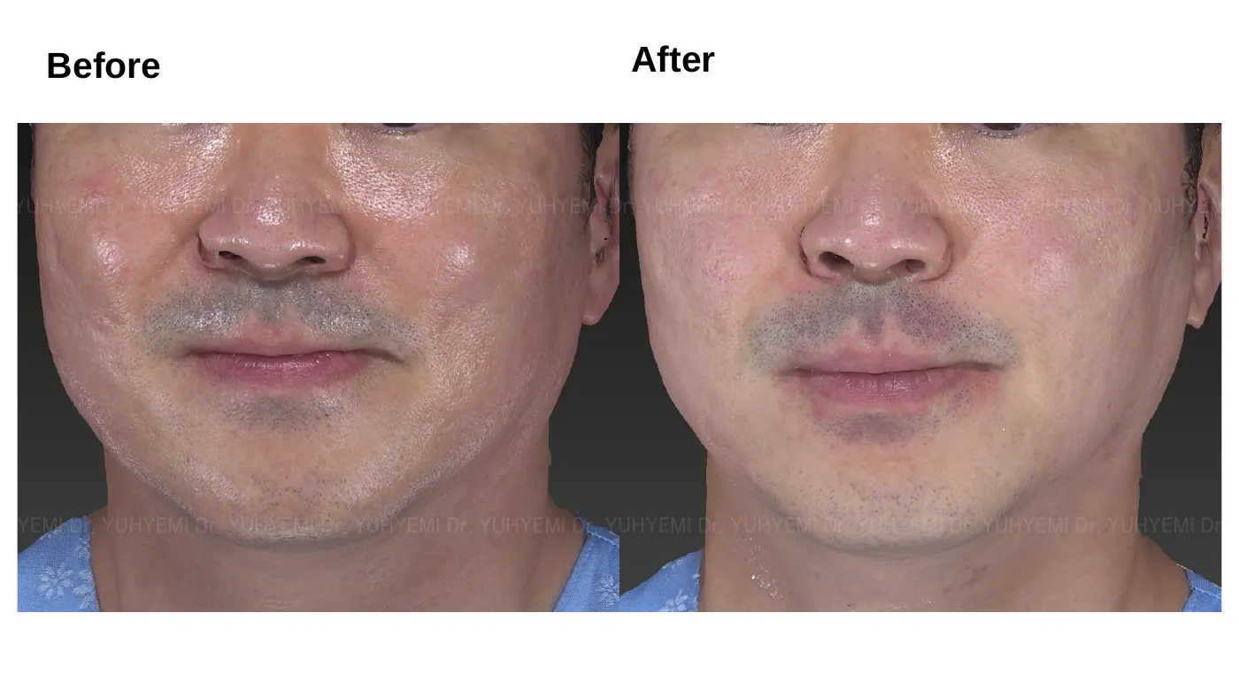 Skin & Barrier before and after, case 5