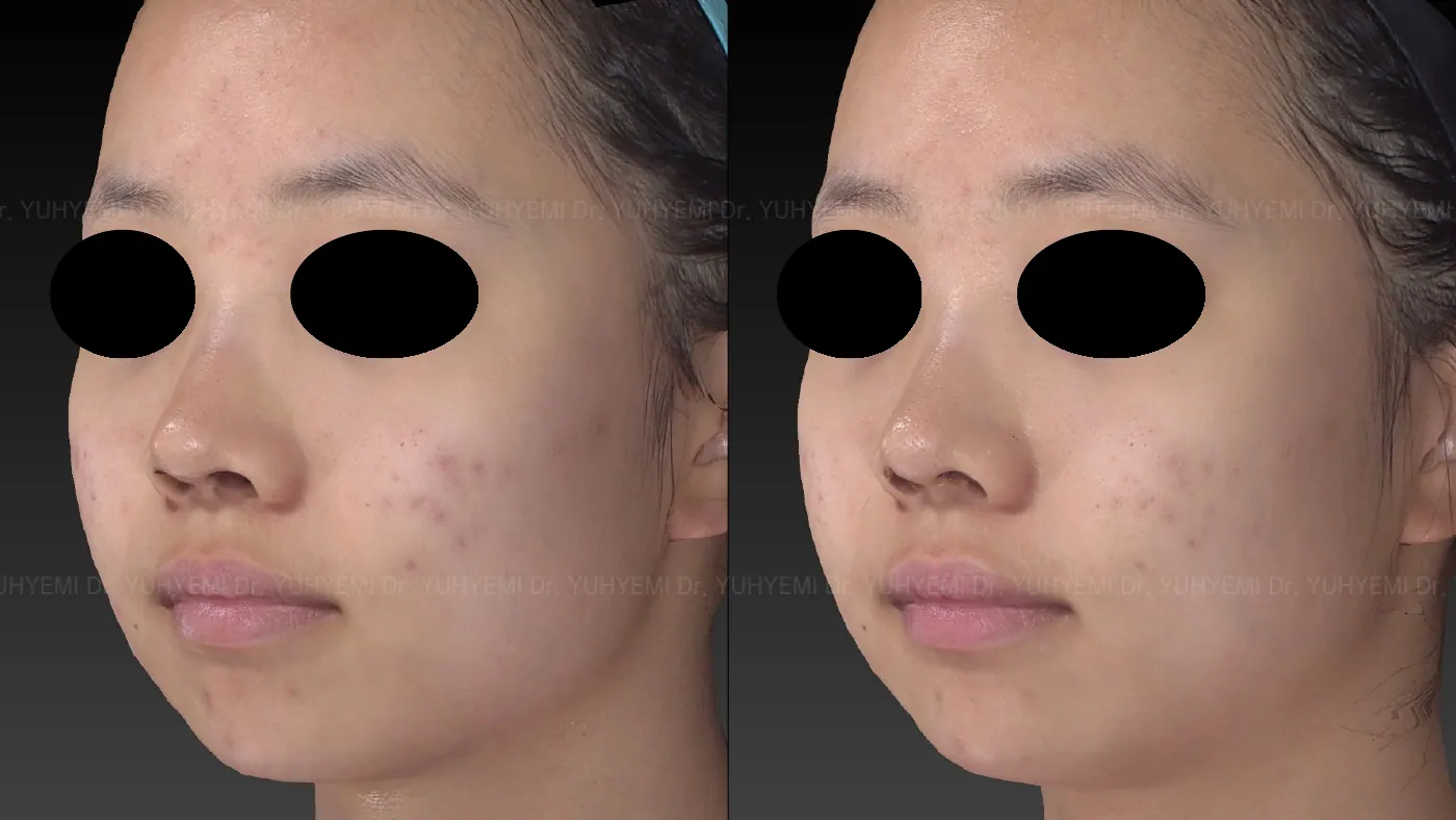 Skin & Barrier before and after, case 6